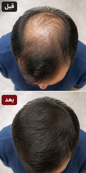 درمان-ریزش-مو