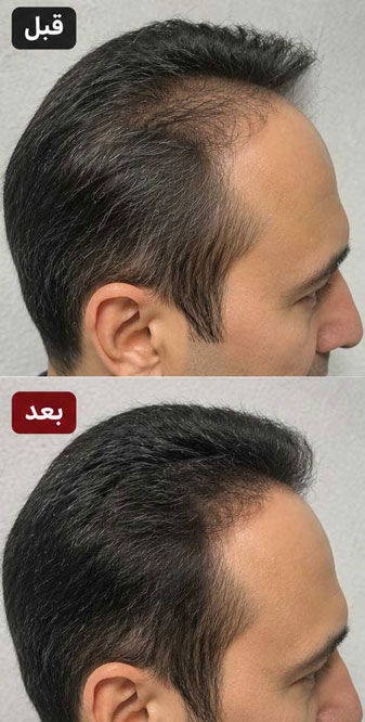 قبل-و-بعد-استفاده-از-منفرد+