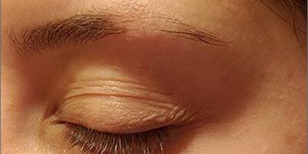 تقویت ابروی ریخته